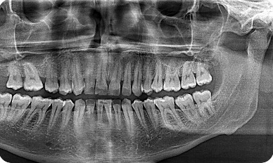Panoramic dental radiograph